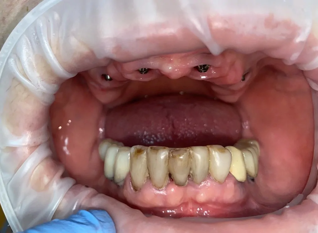 восстановление по методике все-на-4 