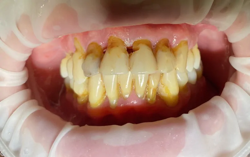 имплантация по методике все-на-4