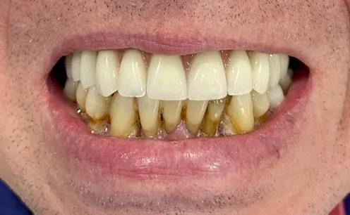 имплантация по методике все-на-4