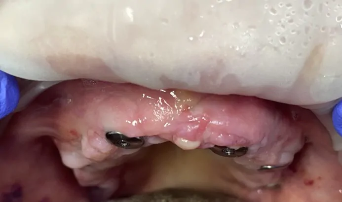 Ситуация до имплантации