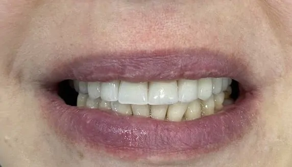 Пациент после имплантации по методике все на шести 