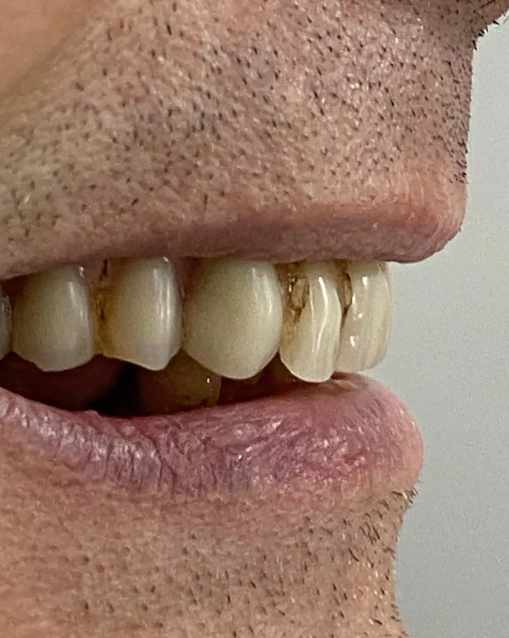 Одномоментная имплантация с немедленной нагрузкой