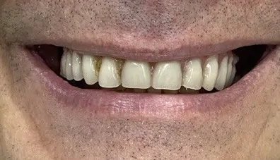 Пациент до имплантации