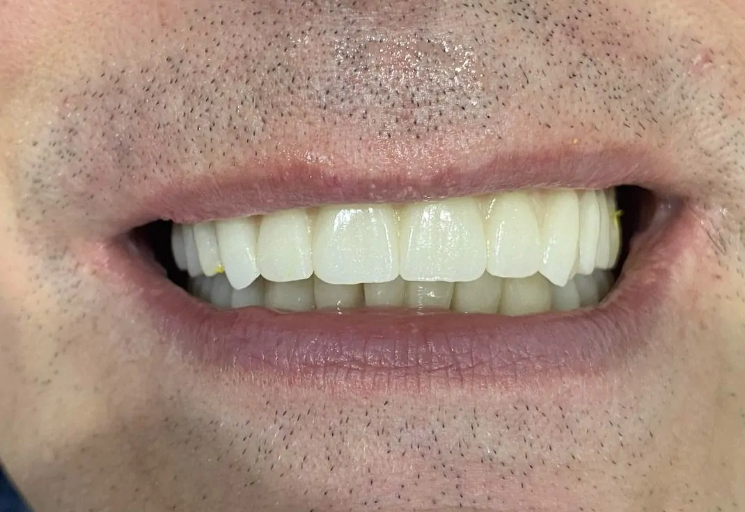 результат имплантации