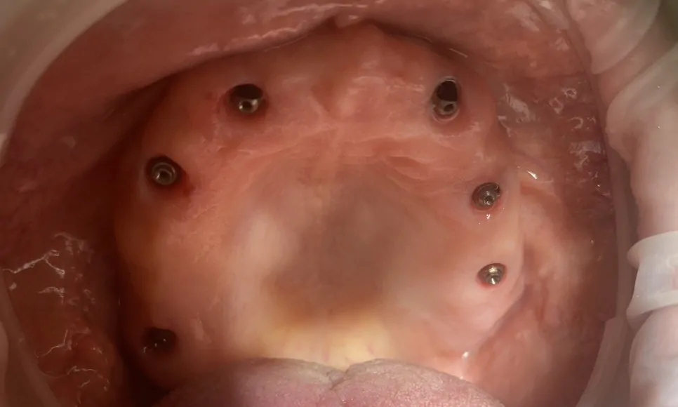 имплантация