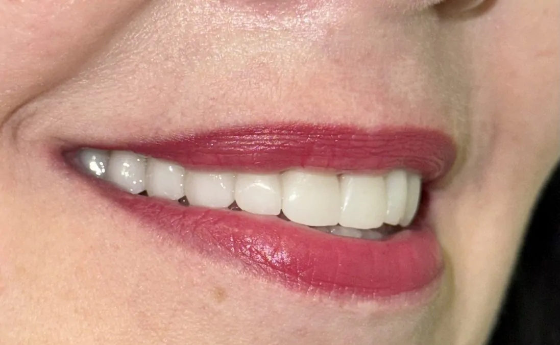 результат имплантации зубов в Минске