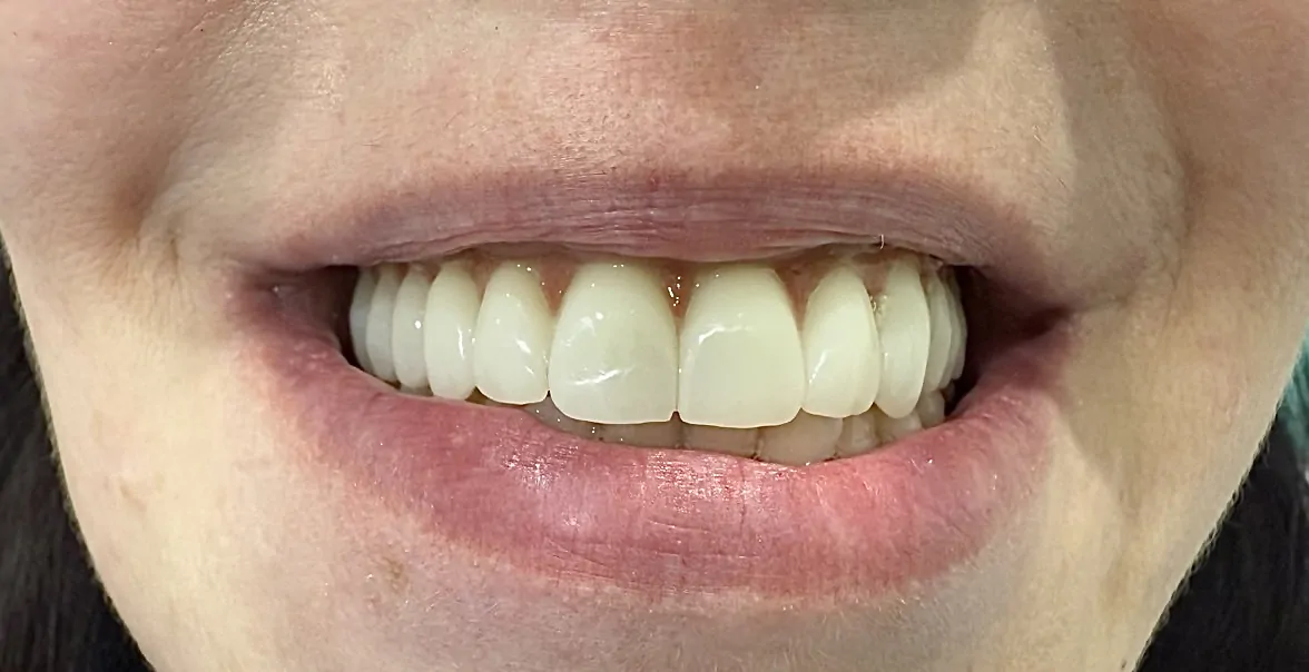 Фиксация коронок из диоксида циркония на имплантатах.