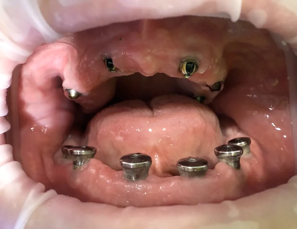 Комплексная одноэтапная имплантация зубов верхней и нижней челюсти