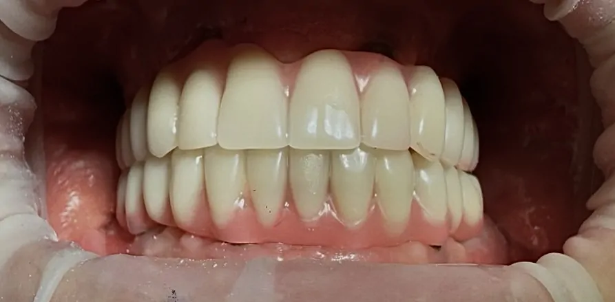 Протезирование на имплантатах