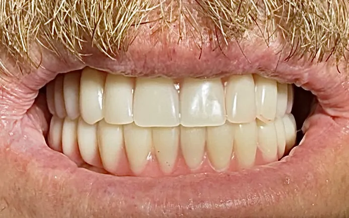 Результат имплантации зубов в Минске